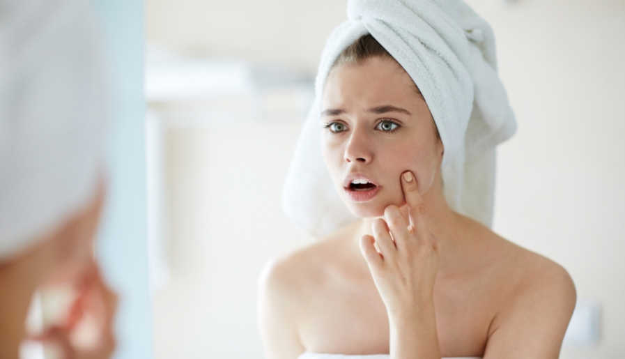 Crash course in acne skin care