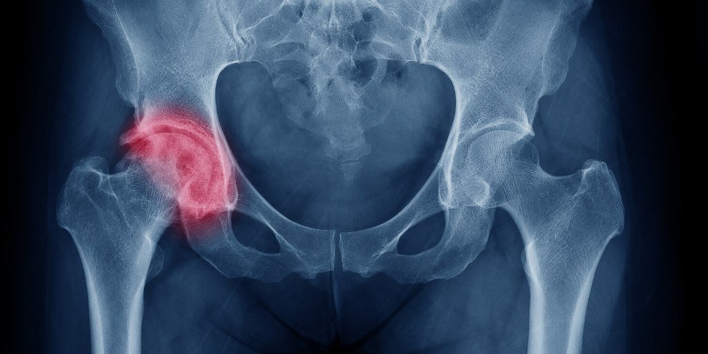 Xray showing Physical discomfort in the hip, which varies from mild to severe