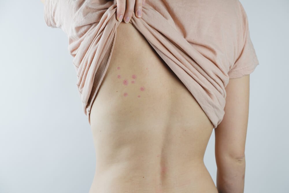 A woman with a case of bed bug bites on her back from her mattress.